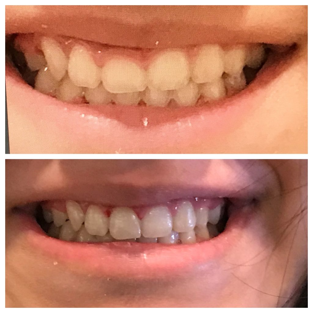 Gingivectomy Before And After