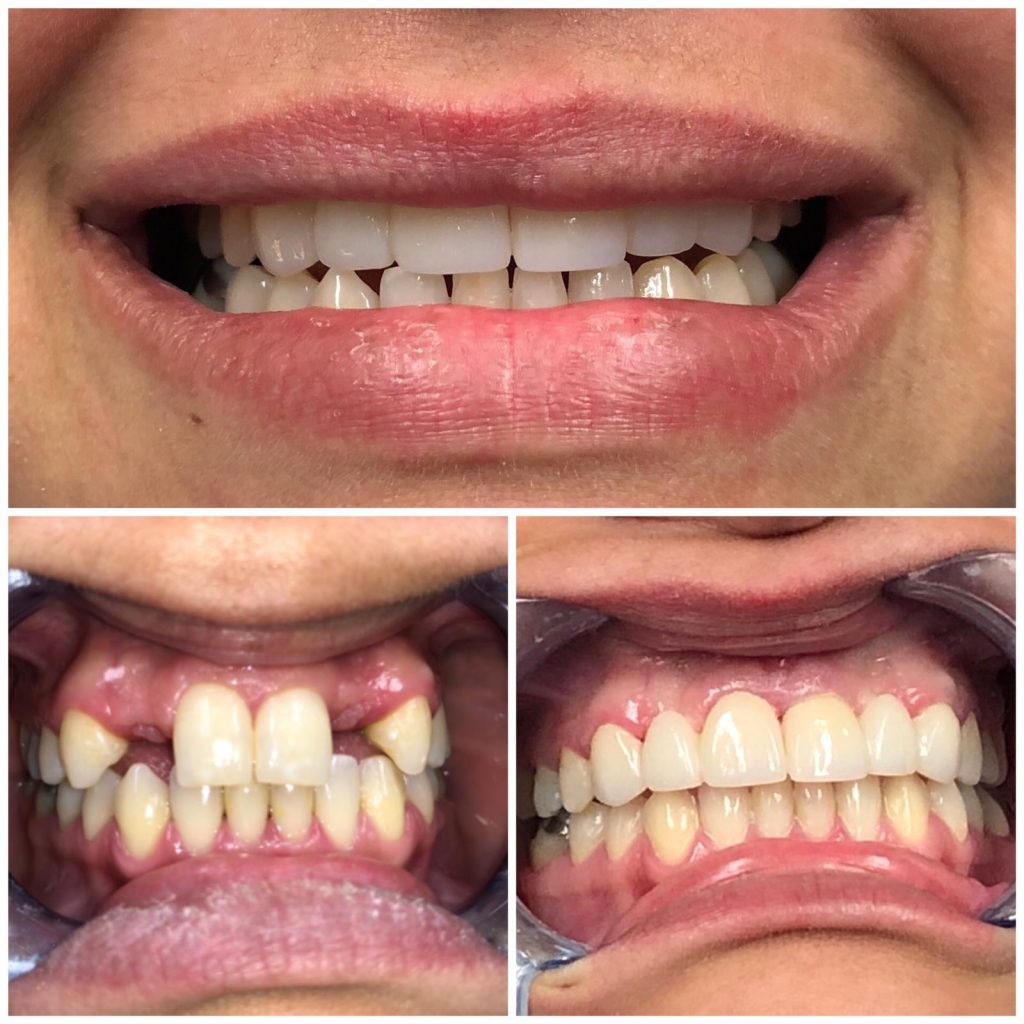 Misiing Front Teeth Before And After