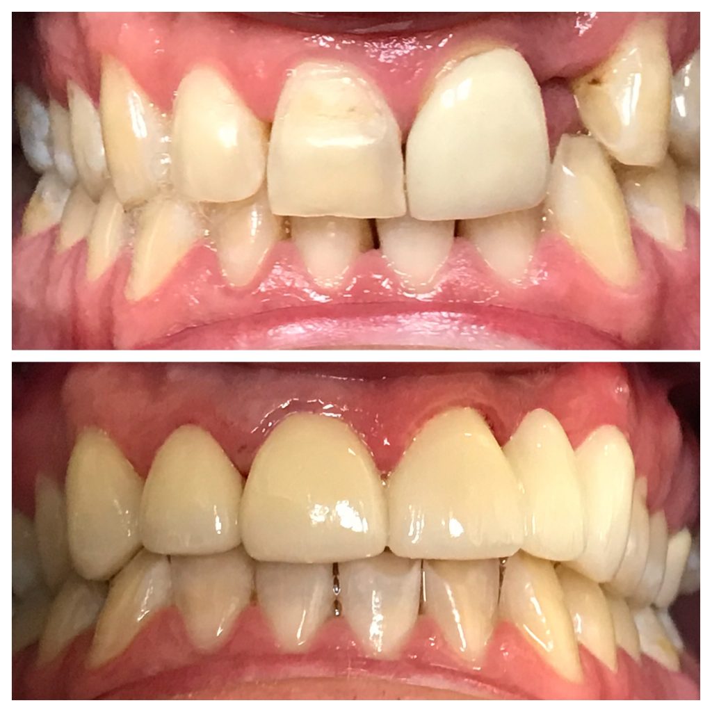 Missing Front Tooth Before After
